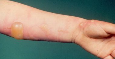 Brûlure_Loughborough University